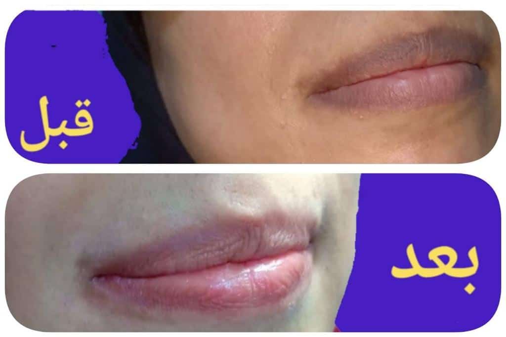 Supplying laser lips in a freshness center in Hurghada